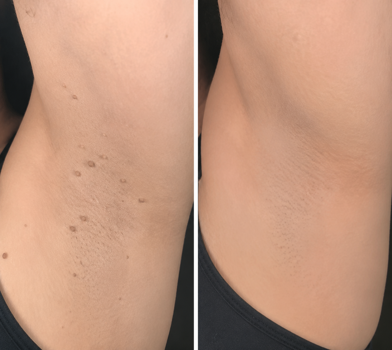 🔥Ends Today: 70% OFF!✨KLENIMORE™2-in-1 Microneedle & Hydrocolloid Patch🍀