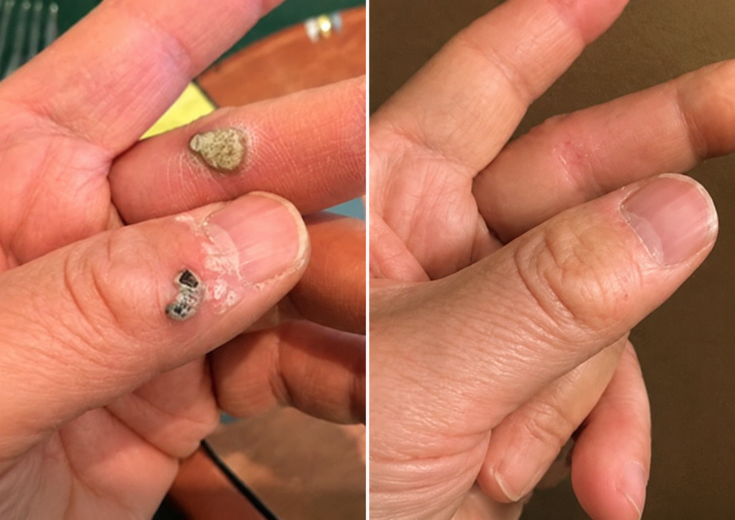 🔥Ends Today: 70% OFF!✨KLENIMORE™2-in-1 Microneedle & Hydrocolloid Patch🍀