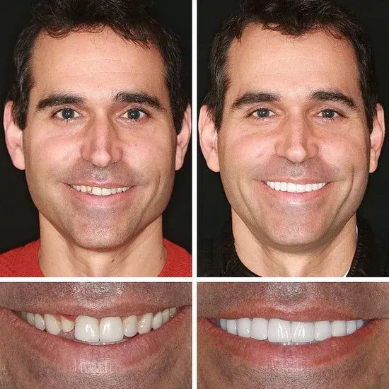 ⏰Ends Today: 50% OFF! 🌎KLENIMORE™ Custom-Fit — Designed for Comfort and a Natural-Looking Smile